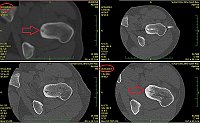 Obr. 6. RFA osteoidního osteomu levé kyčle a CT kontrola po roce