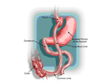 Sindrome de dumping causas