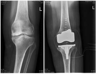 artróza kolene operace