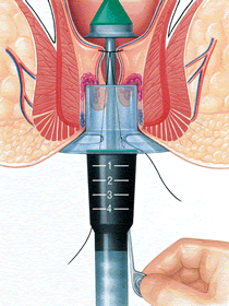Operace hemoroidů - Longova metoda