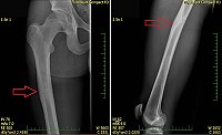 Obr. 1 Osteoidní osteom v rentgenovém obraze