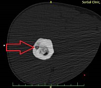 Obr. 2 Osteoidní osteom v CT obraze