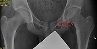 Obr. 5. Nidus osteoidního osteomu v krčku levé kyčle na RTG snímku